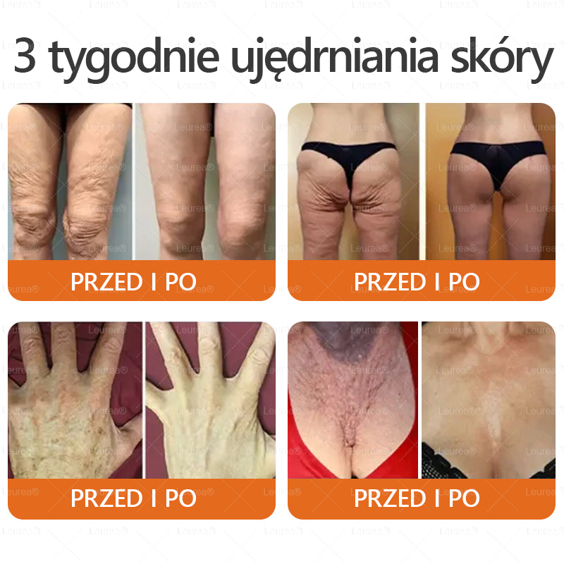 🎁💛🎁 Gratulacje! Dziś jesteś w gronie szczęśliwych klientów – otrzymujesz do 50% zniżki! Zadbaj o gładką, jędrną skórę i odzyskaj pewność siebie oraz urodę!