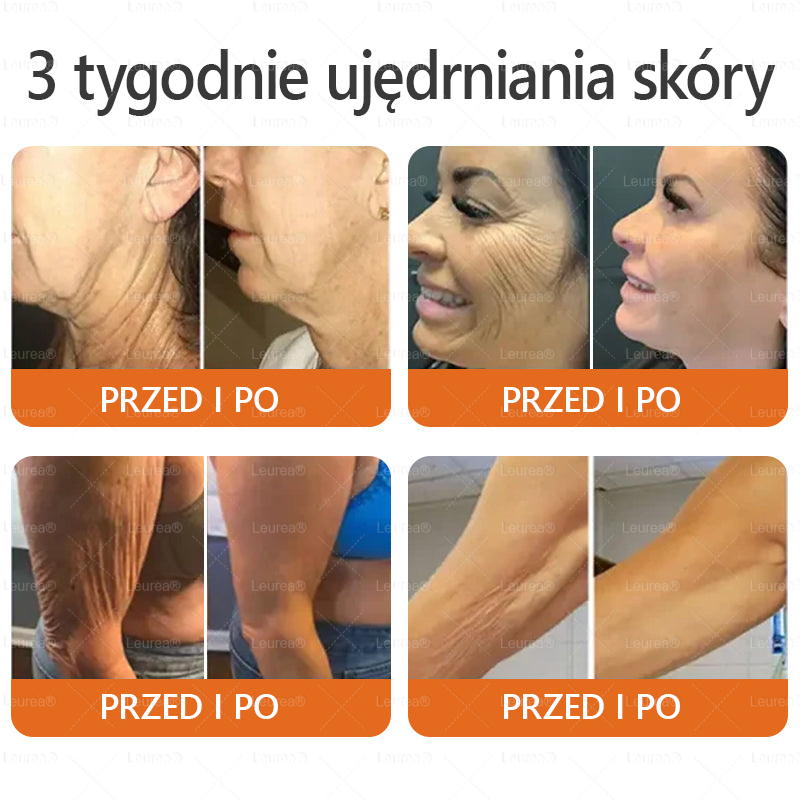 🎁💛🎁 Gratulacje! Dziś jesteś w gronie szczęśliwych klientów – otrzymujesz do 50% zniżki! Zadbaj o gładką, jędrną skórę i odzyskaj pewność siebie oraz urodę!